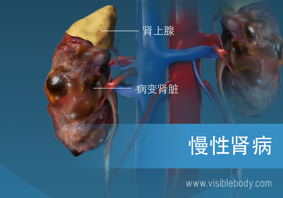 健康肾脏和患病肾脏的比较