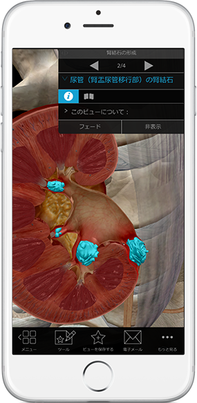 kidney-stones-ureter-pathology-physiology-iphone_ja