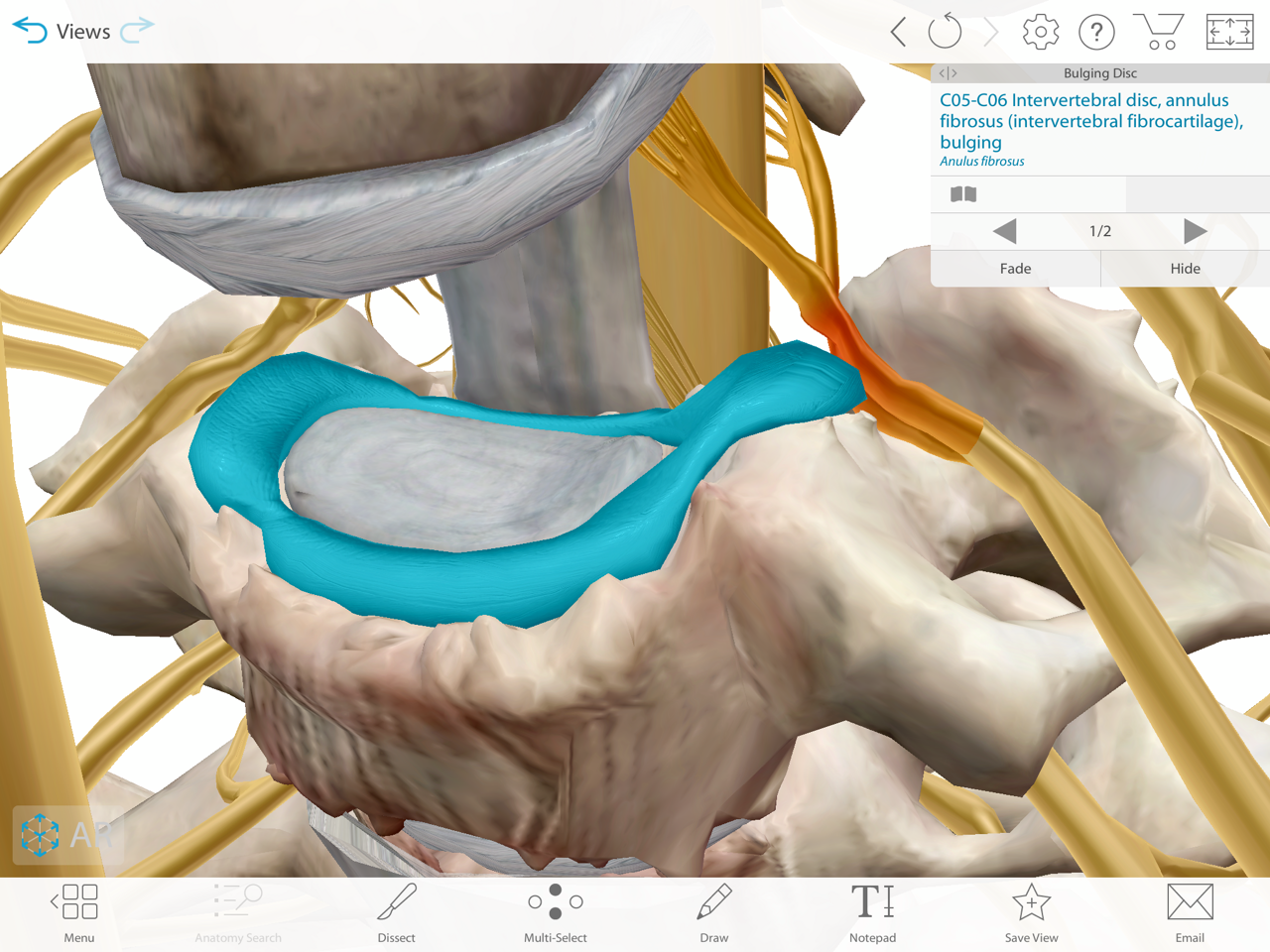 3D model of vertebra with bulging disc